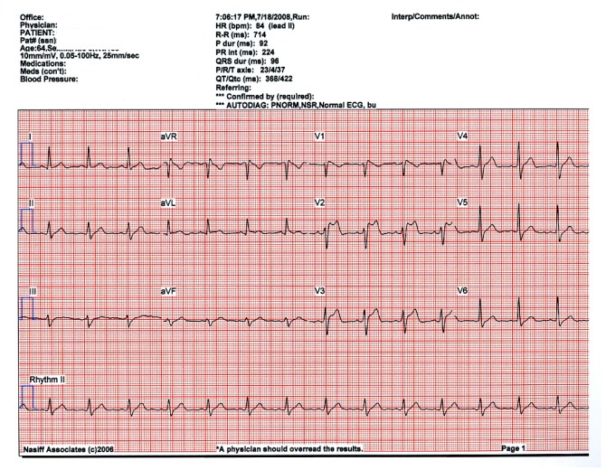 Comparison of handheld 1-lead ECG/EKG recorders