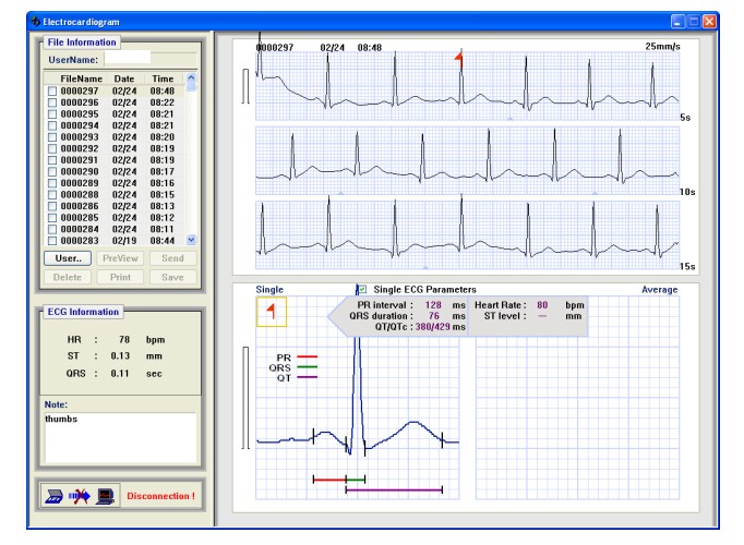 Comparison Of Handheld 1-lead ECG/EKG Recorders