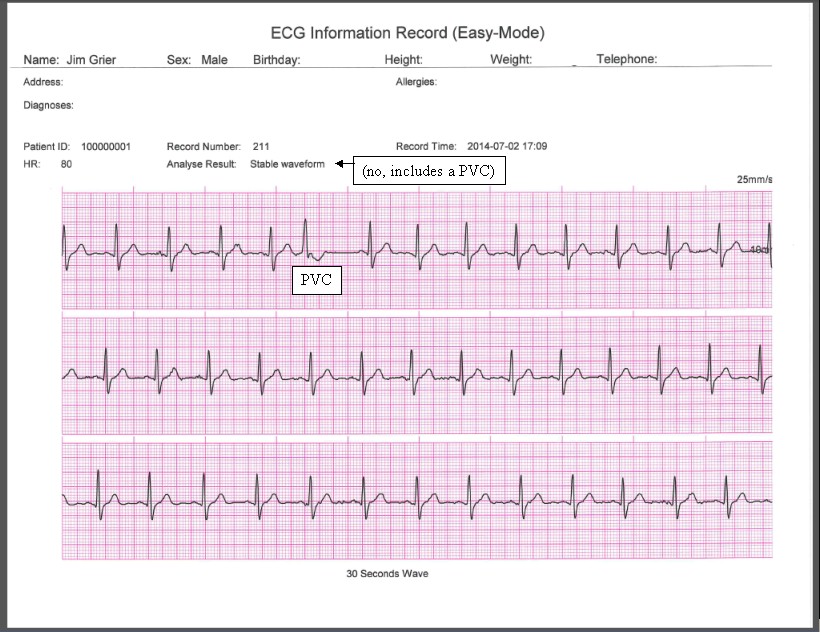 Comparison of handheld 1-lead ECG/EKG recorders