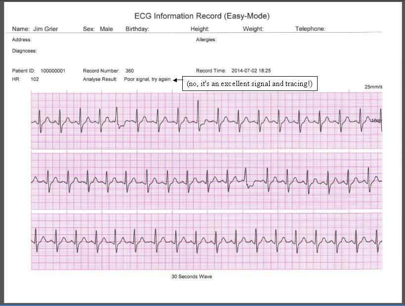 Comparison Of Handheld 1-lead Ecg Ekg Recorders