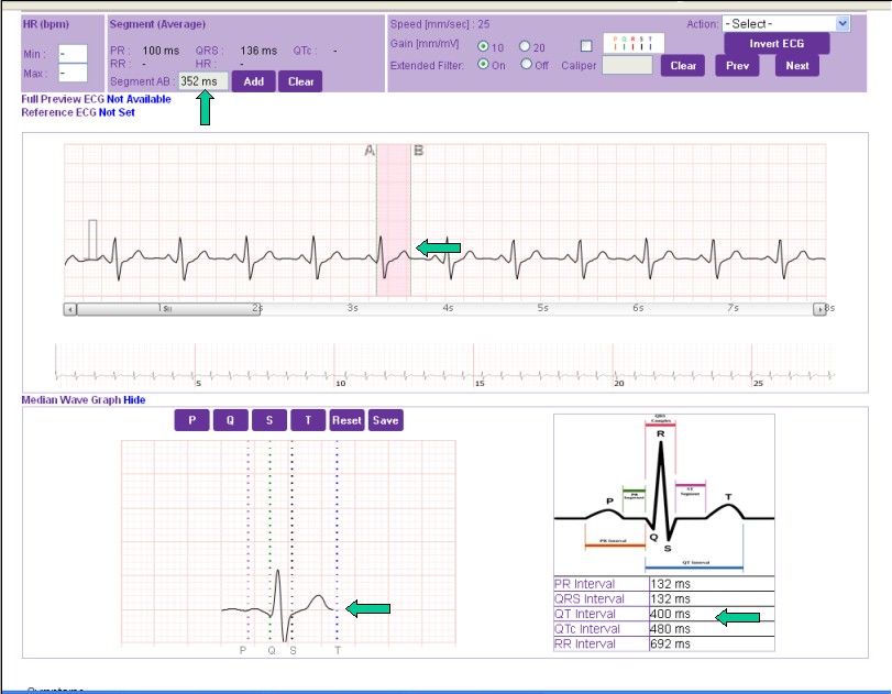 Comparison of handheld 1-lead ECG/EKG recorders