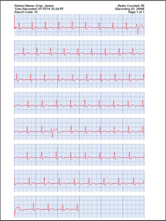 Comparison of handheld 1-lead ECG/EKG recorders