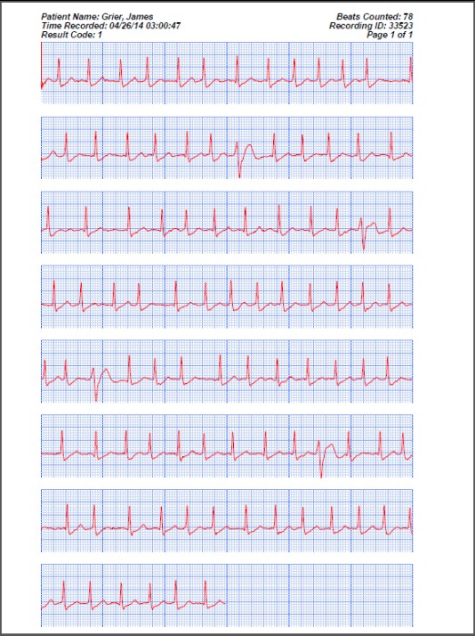 Comparison of handheld 1-lead ECG/EKG recorders